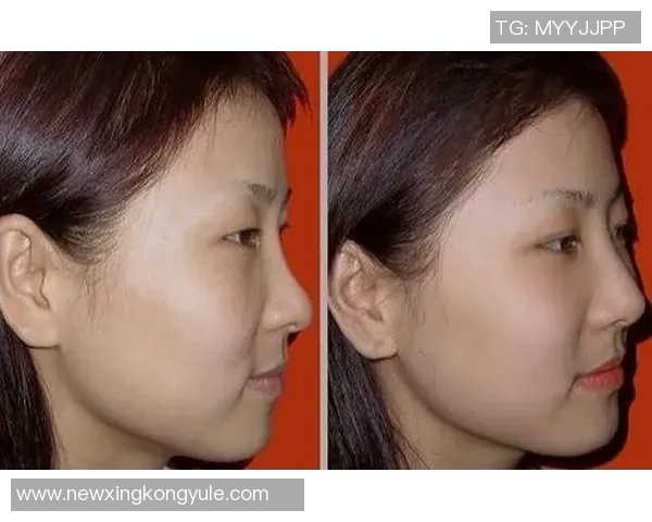 小卡解释鼻子出血原因只是轻微划伤并遭遇眼部意外碰撞